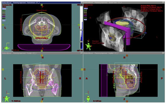 Abbildung: VMAT-Plan zur Bestrahlung eines Patienten mit Rektum-Karzinom, Darstellung in allen Raumebenen