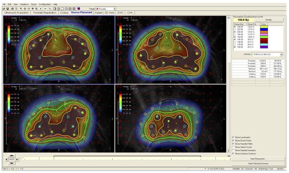 Abbildung: Ultraschallbild von vier Schichten der Prostata während des Einbringens von Jod-125-Seeds (LDR-Brachytherapie). Dosisverteilung: kalte Farben = geringe Dosis; warme Farben = hohe Dosis