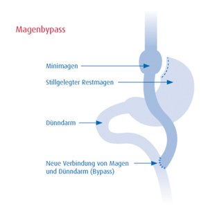 Abbildung: Magenbypass