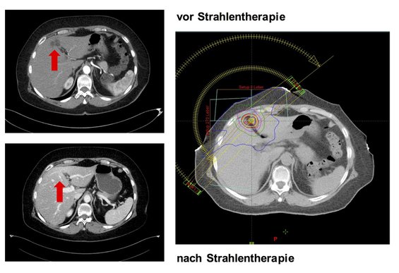 Abbildung: CT vor STX-RT und nach STX-RT: Lebermetastase nach Bestrahlung nicht mehr vorhanden (jeweils roter Pfeil); großes Bild: Planungs-CT für die entsprechende STX-RT