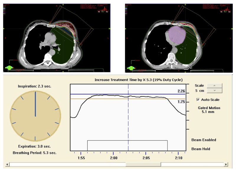 Abbildung: Ausschnitt aus dem Bestrahlungsplan und der Bestrahlungsphase einer Patientin mit Brustkrebs; Schonung des Herzens (violett eingezeichnet)