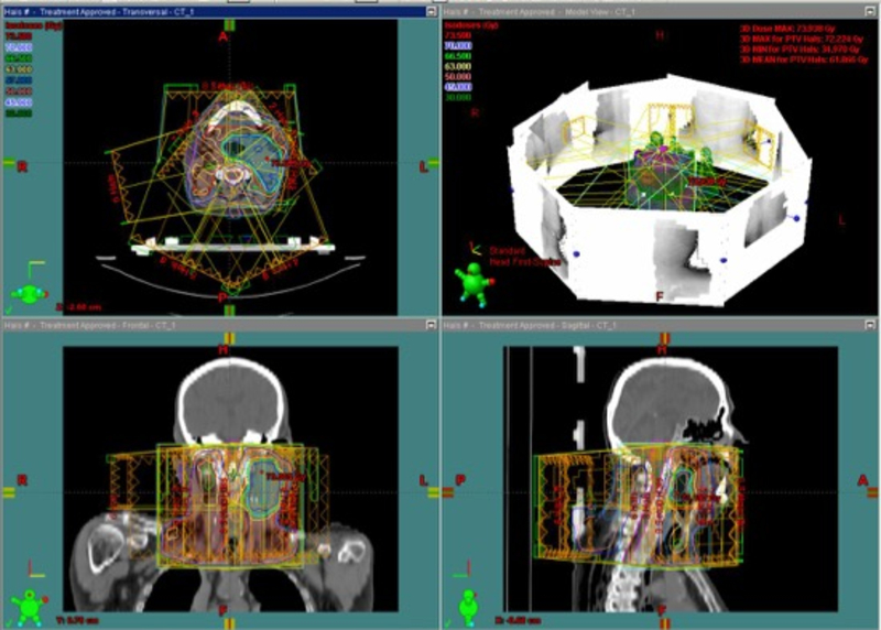 Abbildung: IMRT-Plan zur Bestrahlung eines Patienten mit Tumor im HNO-Bereich, Darstellung in allen Raumebenen