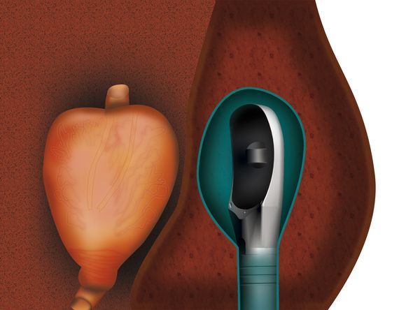 1. Der Applikator wird auf Höhe der Prostata platziert. Die Harnröhre führt durch die Prostata hindurch, darüber befindet sich die Blase. Der Applikator wird von einem Ballon mit Kühlmittel umhüllt. In der Mitte befindet sich der Bildgebungsschallkopf.