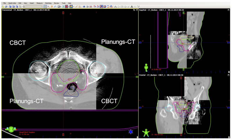 Abbildung: Überprüfung der Lagerung eines Patienten mit Prostata-Karzinom während der Bestrahlungssitzung mittels Cone-Beam-CT (CBCT); Planungs-CT und Cone-Beam-CT übereinandergelegt; Betrachtungsweise über 4 Sektoren
