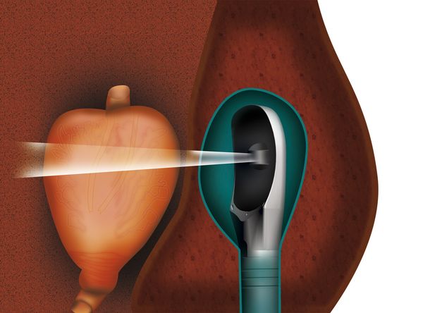 2. Der Bildgebungsschallkopf erstellt ein präzises 3 D-Ultraschallbild der gesamten Prostata, das als Grundlage für die Therapieplanung dient.