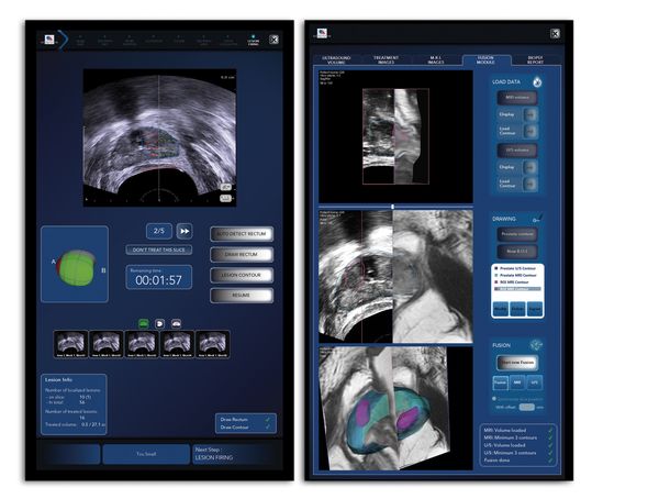 3. Im Focal One können MRT-Bilder und/oder 3D-Biopsien eingelesen und mit dem 3D-Ultraschallbild fusioniert werden. Der Arzt plant die Behandlung dann millimetergenau am Bildschirm.