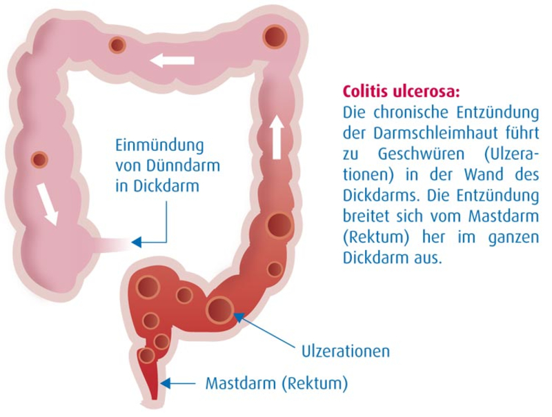 Abbildung: Colitis ulcerosa